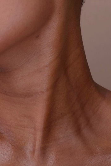 Microneedling