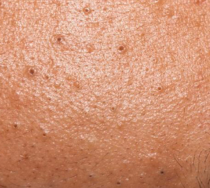 Acne-traject