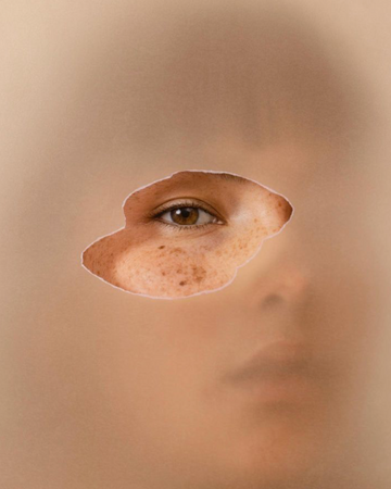 Botox (spierontspanners)